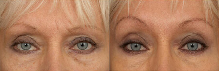 Botox kezelés előtte-utána